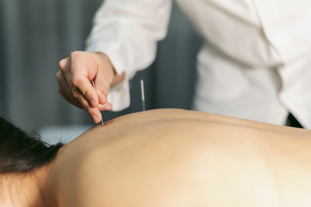Acupuncture Therapy near me