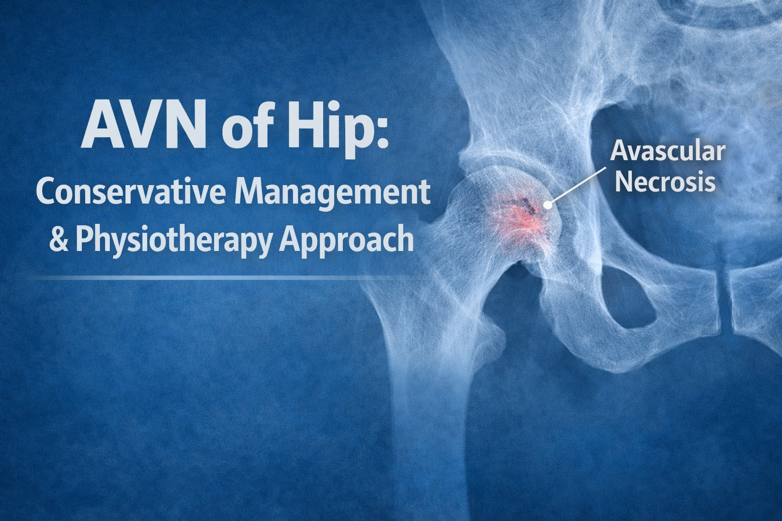AVN of Hip: Conservative Management and Physiotherapy Approach