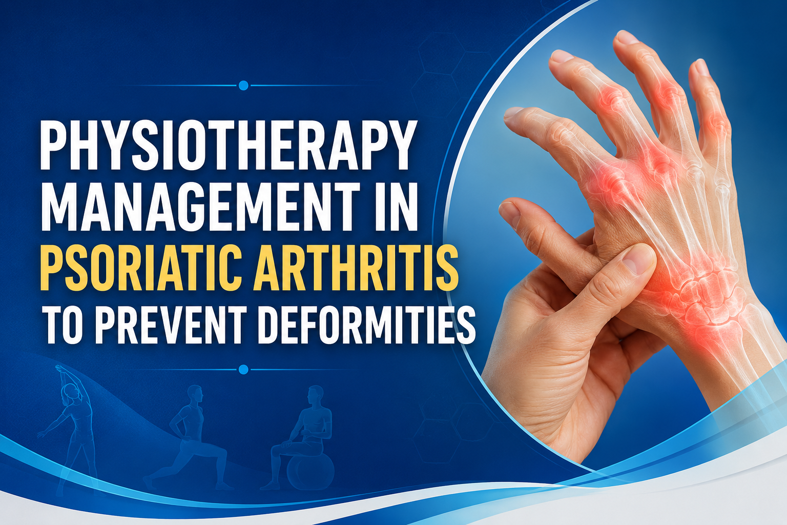 Physiotherapy Management in Psoriatic Arthritis to Prevent Deformities